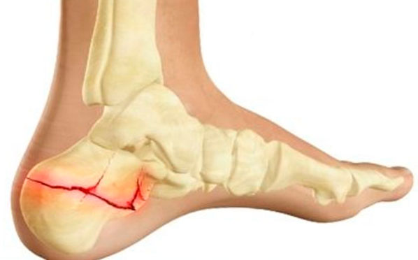Fractura calcaneului