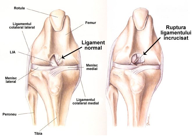 Ruptura ligamentului încrucișat anterior